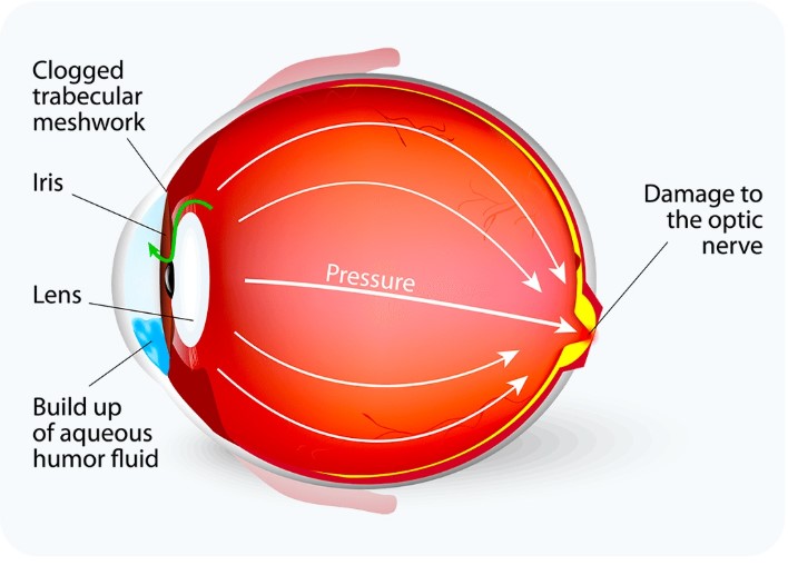 Glaucoma