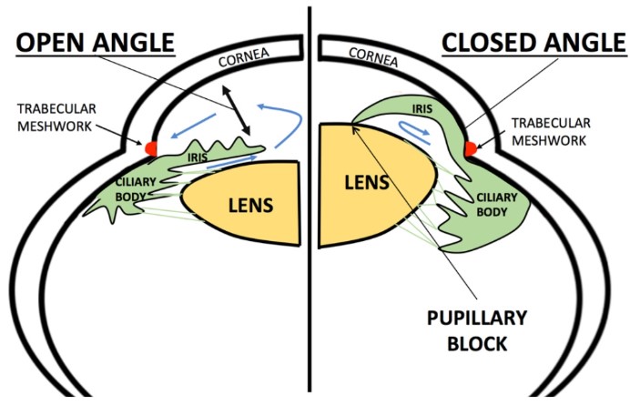 glaucoma