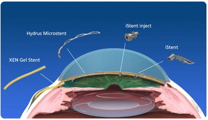 glaucoma_migs