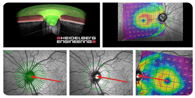 Glaucoma Diagnosis